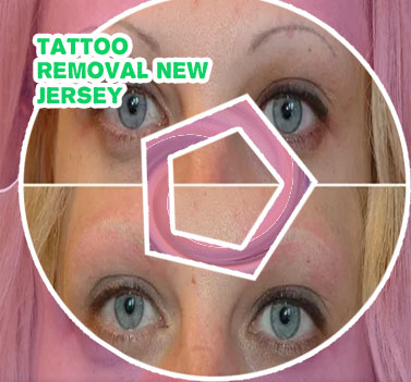 Laser to remove microblading
